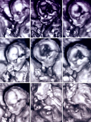 Series of nine 3D fetus ultrasonography pictures