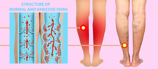 The female legs with veins varicose spider