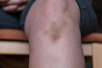 Wunde am Knie - Bluterguss