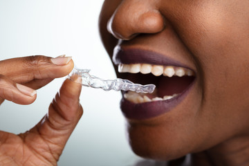 Woman Putting Transparent Aligner In Teeth