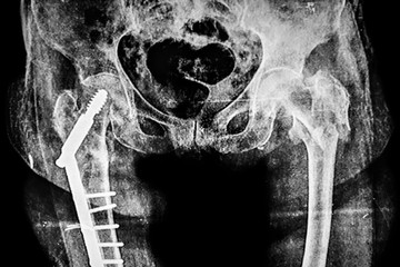 Metal Rod in right leg X-Ray