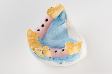 model with artificial analogues of dental implants