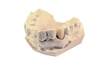 Denture gypsum model isolated on white background.