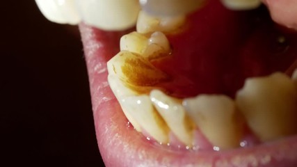 Detail of dental calculus (tartar) on teeth - hardened plaque deposits top view