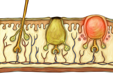 Histology of acne lesions. Illustration showing normal hair with sebaceous glands (left), formation of open comedone (center) and inflammatory papule (right)