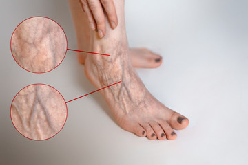 The woman rubs her tired foot. The concept of varicose veins. Close up. Images with magnification of diseased vessels