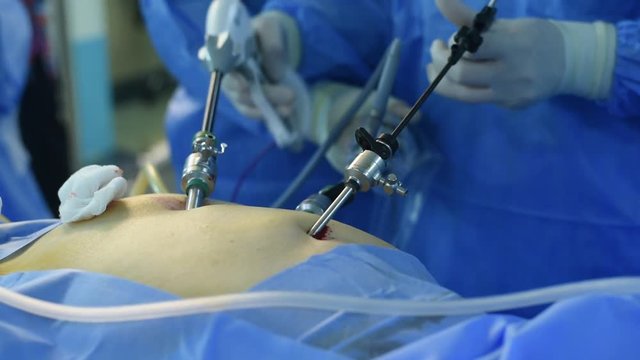 Close-up of surgeon hands performing laparoscopic surgery