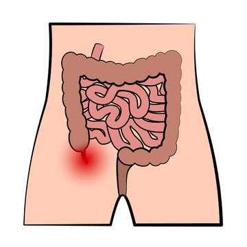 Inflamed appendix. Schematic illustration of appendicitis and the digestive system. Isolated vector on white background.