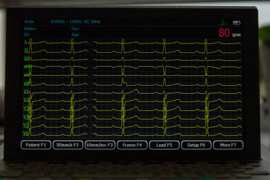 Screen of electrocardiograph device showing twelve yellow ECG cardiography rythm leads. With heart rate.