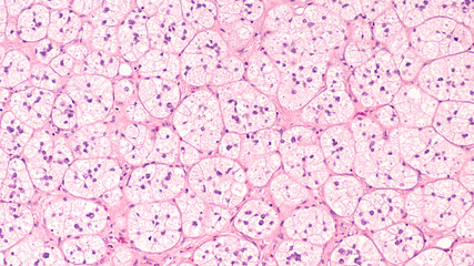 Microscopic image of an adrenal cortical adenoma, a benign tumor of the adrenal gland, which may produce hormones cortisol or aldosterone and lead to Cushing's syndrome or primary hyperaldosteronism.