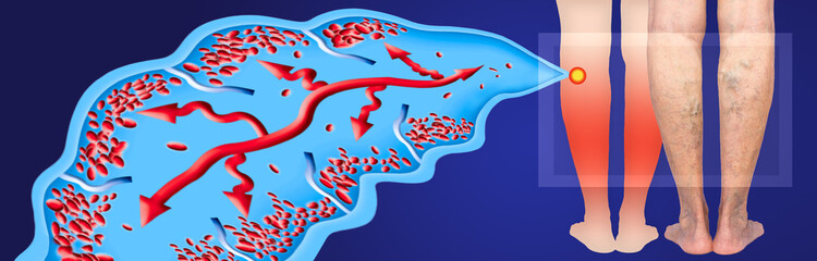 Varicose veins on a female senior legs. The structure of normal and varicose veins.