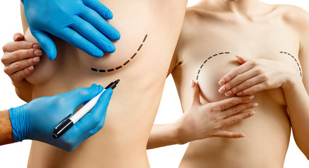 Plastic surgery before female breast correction. - obrazy, fototapety, plakaty