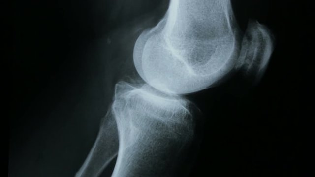Zoom-in on the x-ray plate of the femur and bones of the human knee, in lateral view.