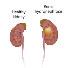 Healthy kidney comparison with hydronephrosis. Distended renal pelvic. Realistic anatomy vector illustration.