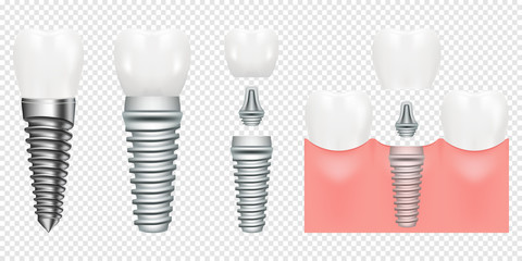 Human teeth and dental implant cut scheme, vector illustration. Dental implant structure with all parts crown, abutment, screw. medical pictorial. Vector illustration - obrazy, fototapety, plakaty