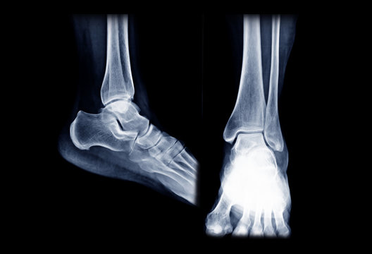 X-ray ankle or Radiographic image or x-ray image of right ankle joint  AP and Lateral  view for diagnosis of frature ankle.