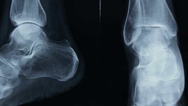 Zoom-in of the radiographic plate of tibia and fibula and of bones of the human foot.