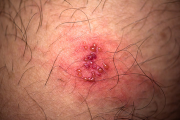 skin rash and blisters on body (Shingles on men herpes zoster)