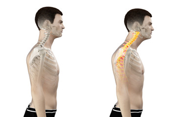 3d rendered medically accurate illustration of a man with a forward head posture - obrazy, fototapety, plakaty