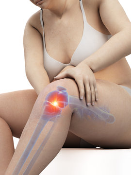 3d rendered medically accurate illustration of an overweight womans painful knee joint