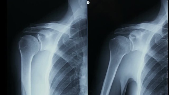 Zoom-out of the X-ray plate detail of x-ray of human shoulder bones