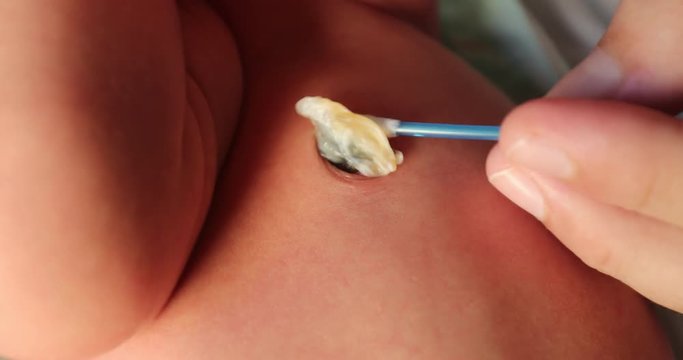 Cleaning newborn baby umbilical cord, first week of life