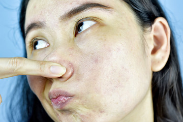 Acne skin problem, Asian woman annoy and bored about hormonal pimples, Young girl hand pointing at...