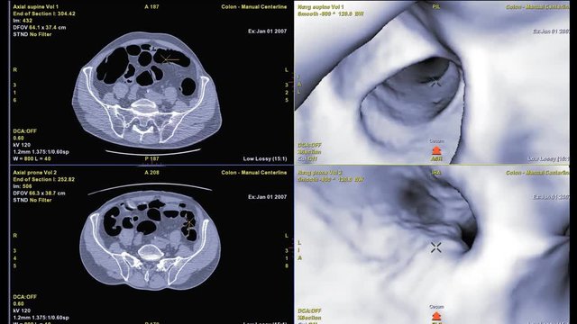 CT colonography compare Axial and 3D movie file for screening colorectal cancer. Check up Screening cancer of colon.
