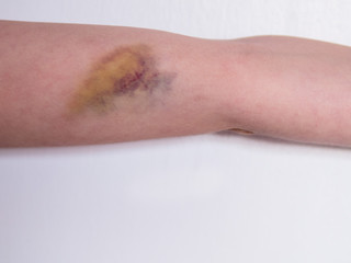 Fototapeta premium Bruise on a child arm. Close up.