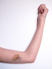 Bruise on teenager arm, concept injury. medicine,