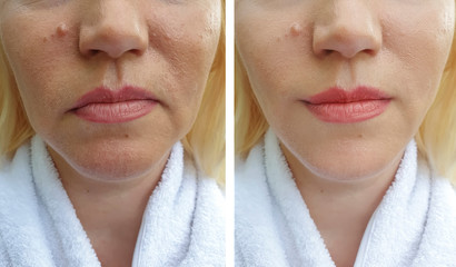 woman face wrinkles before and after treatments