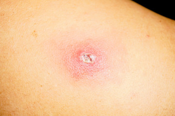 Fototapeta premium Acne skin problem on back side man surface