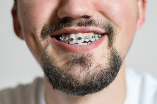 Close up of a young man with braces smiling. Macro shot of a young man with braces on a white background