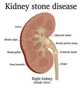 Illustration of Kidney stone disease