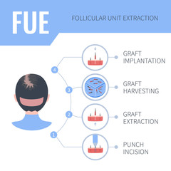 Hair transplant female alopecia treatment by FUE. 4 steps infographics. Stages of follicular unit extraction restoration surgery for women. Vector template for transplantation clinics.
