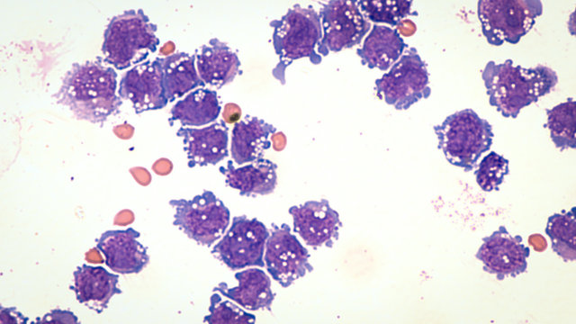 Malignant effusion cytology: microscopic image of diffuse large B-cell lymphoma, a type of non Hodgkin lymphoma.  