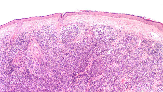 Microscopic image (photomicrograph) of a Merkel cell carcinoma, a highly aggressive type of skin cancer, derived from neuroendocrine cells, typically of the face, head or neck.