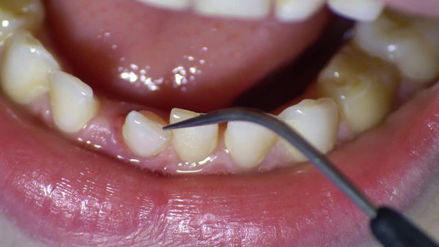 Dentist Inspecting Loose Tooth with Dental Probe