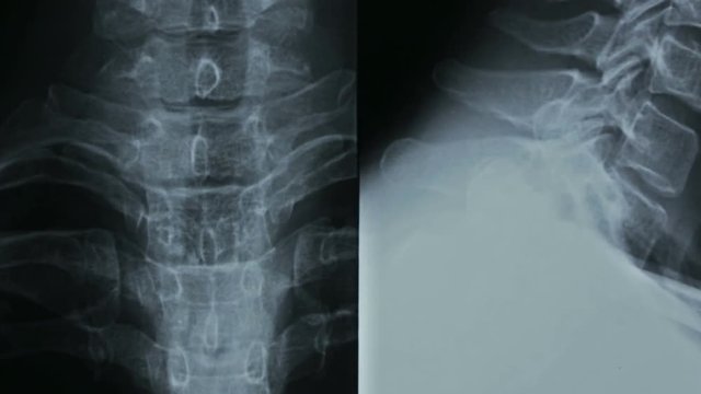 Zoom-in of X-ray, spine cell bone, human cervical bone.