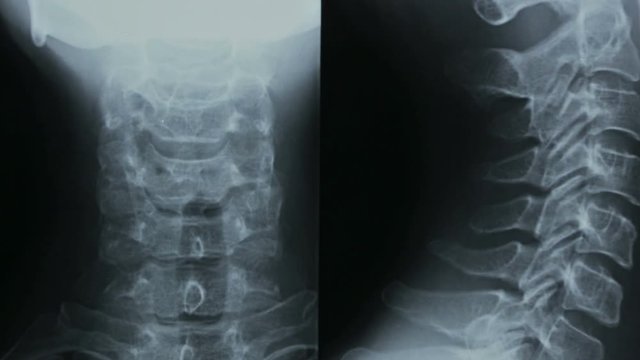 Zoom-in of X-ray, spine cell bone, human cervical bone.