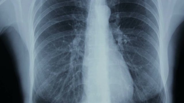 Zoom-in video of X-ray details of human thorax.