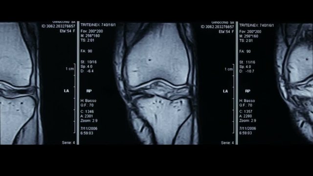 Zoom-in video of R.M.N. Nuclear magnetic resonance, of human knees, with cross-section and sagittal section.