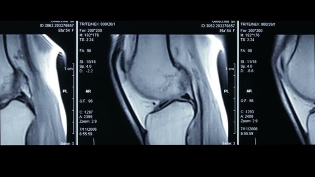 Zoom-in video of R.M.N. Nuclear magnetic resonance, of human knees, with cross-section and sagittal section.