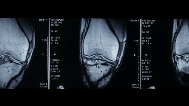 Zoom-in video of R.M.N. Nuclear magnetic resonance, of human knees, with cross-section and sagittal section.