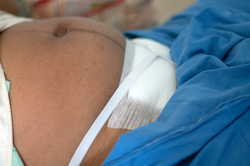Surgical incision, childbirth