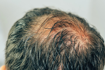 Mesotherapy of hair and head. Traces of injections on the head after therapy. Male pattern...
