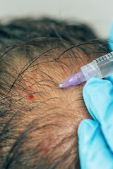 Mesotherapy of hair and head. Injections in the head. Fighting hair loss in men. Men's bald spot in...