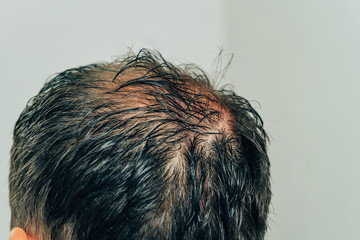 Mesotherapy of hair and head. Traces of injections on the head after therapy. Male pattern...