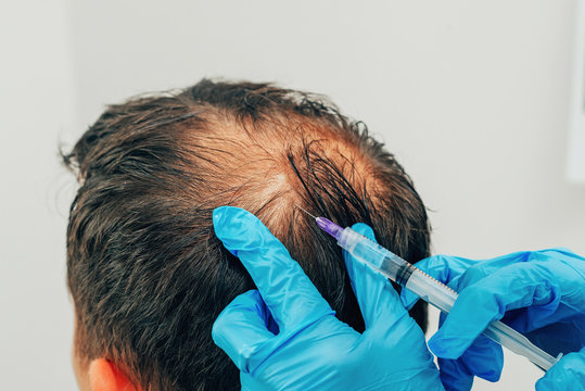 Mesotherapy of hair and head. Injections in the head. Fighting hair loss in men. Men's bald spot in the center of the head at the crown. The hands of the cosmetologist trichologist and the head