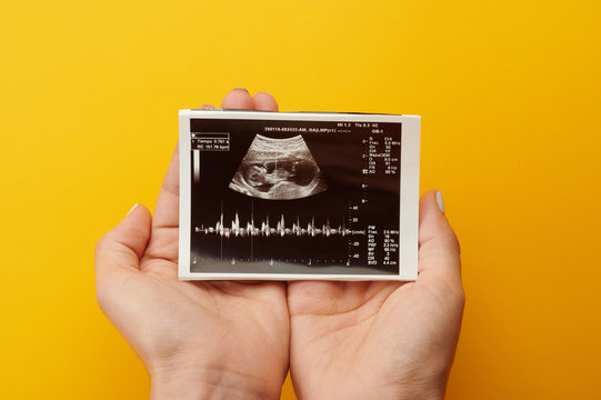 Woman hold ultrasound picture